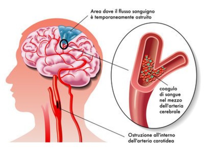 In Valle 200 nuovi casi di ictus ogni anno