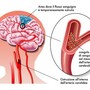 In Valle 200 nuovi casi di ictus ogni anno