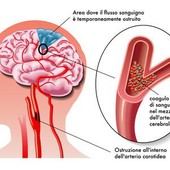 In Valle 200 nuovi casi di ictus ogni anno